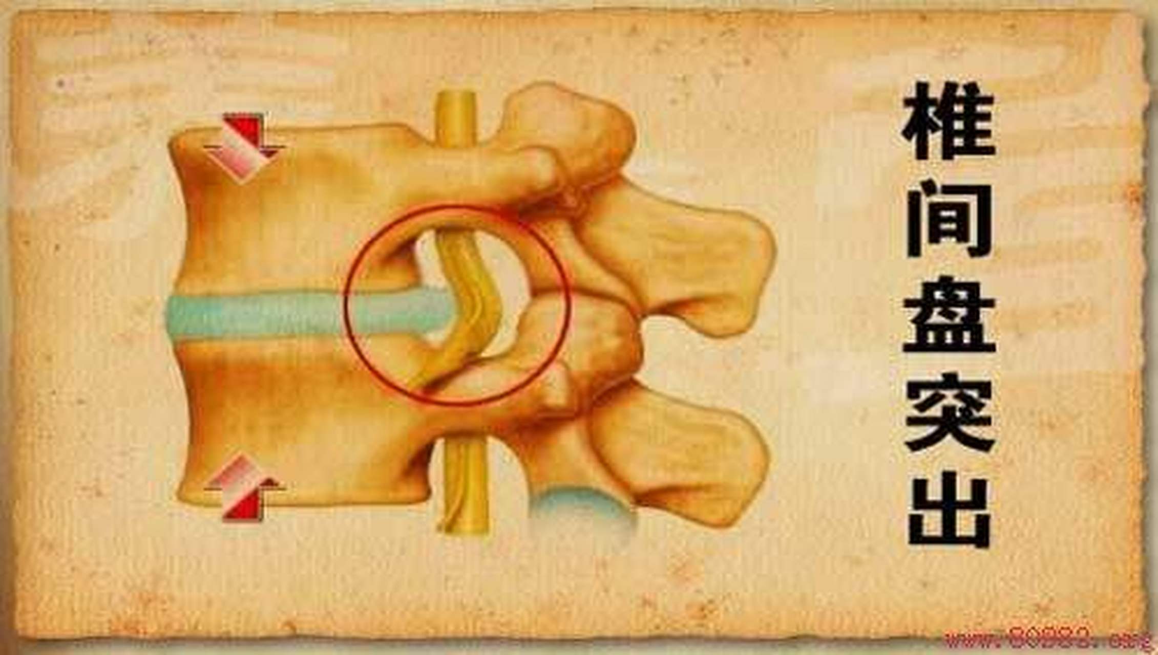 椎间盘突出最佳治方法(椎间盘突出最佳治疗方法) 椎间盘突出最佳治方法(椎间盘突出最佳治疗方法)