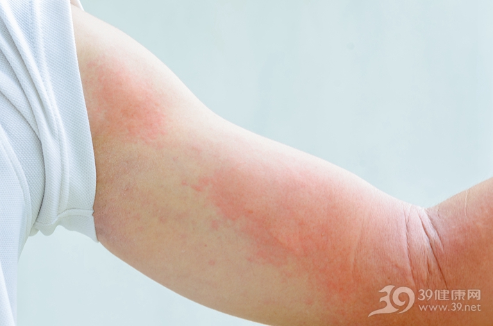 水土不服的症状(北方人来南方水土不服的症状) 水土不服的症状(北方人来南方水土不服的症状)