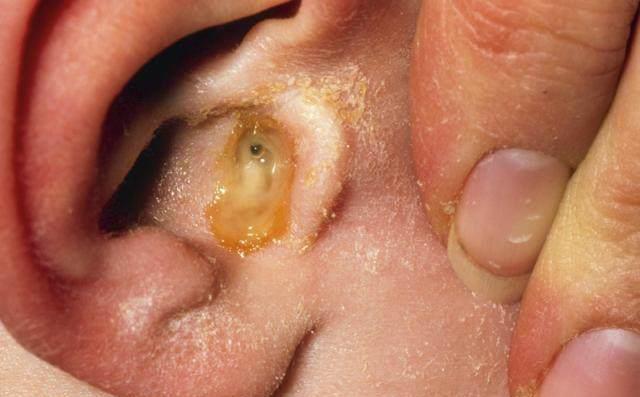 中耳炎的症状主要有以下几点1耳朵疼,会有耳深部的疼痛,而且逐渐的