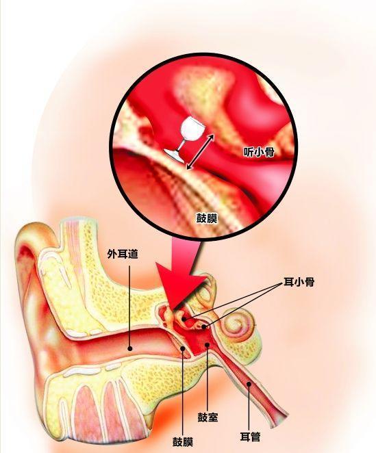 急性中耳炎症状(急性中耳炎症状会发烧吗)